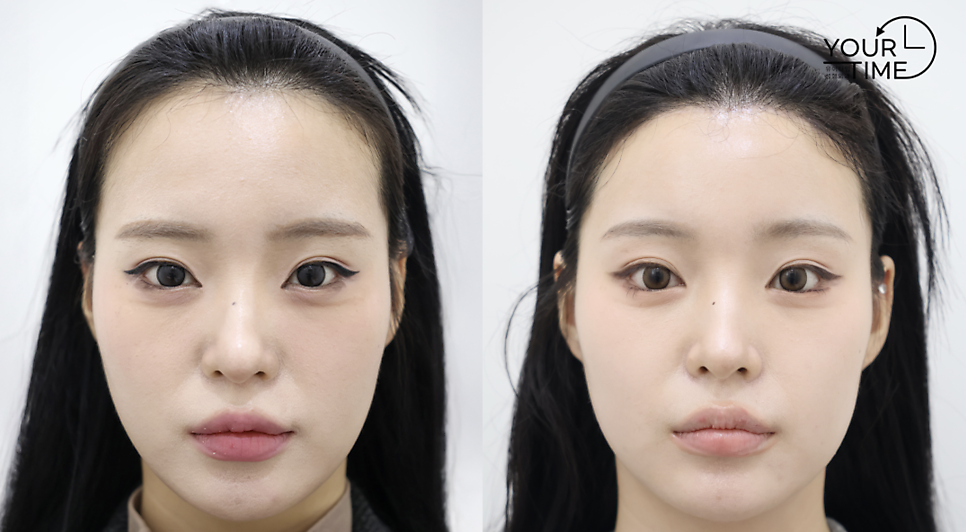 How to Reduce a Large Forehead Significantly (Feat. M-Shaped Hairline Recession) — 15