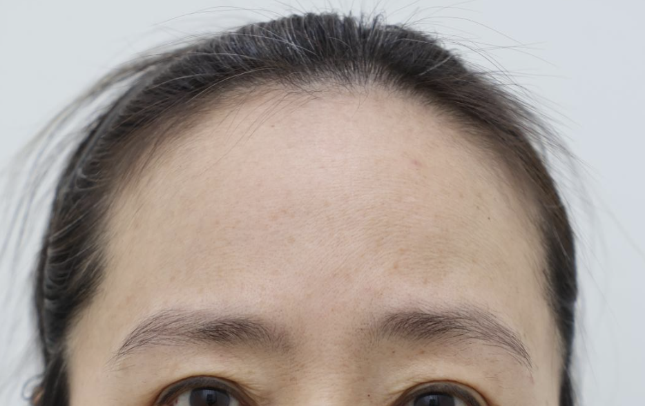 Forehead Reduction Self-Check List: Should You Get the Surgery or Not? — 7