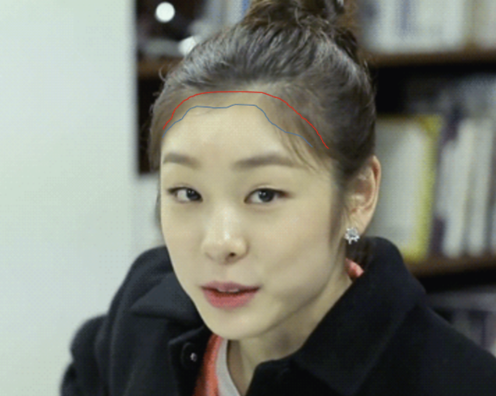 Forehead Reduction Self-Check List: Should You Get the Surgery or Not? — 10