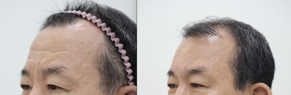 Forehead Reduction Self-Check List: Should You Get the Surgery or Not? — 12