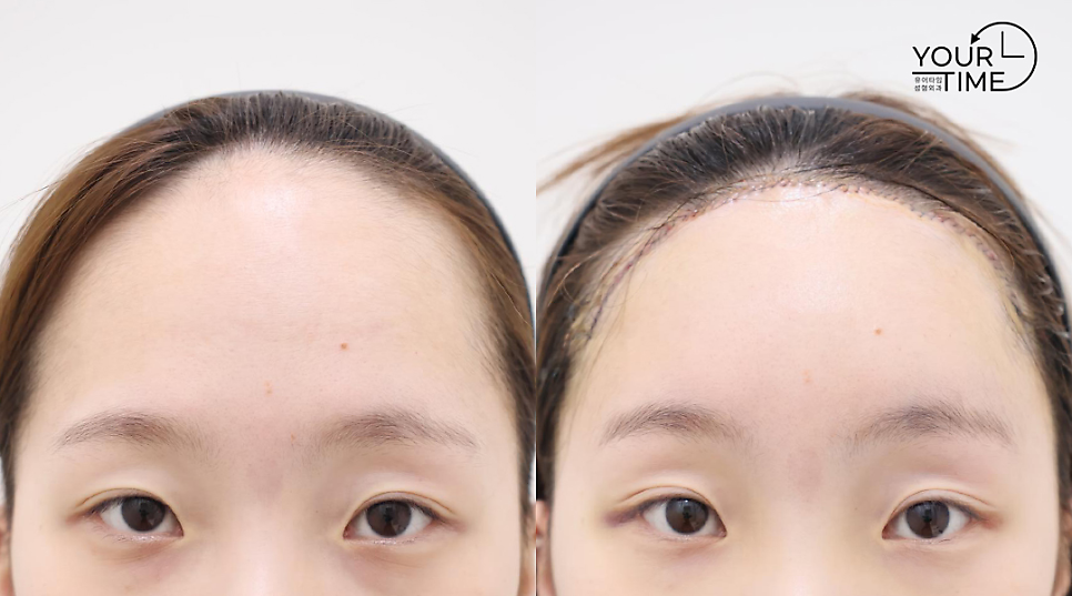 Forehead Reduction Self-Check List: Should You Get the Surgery or Not? — 13
