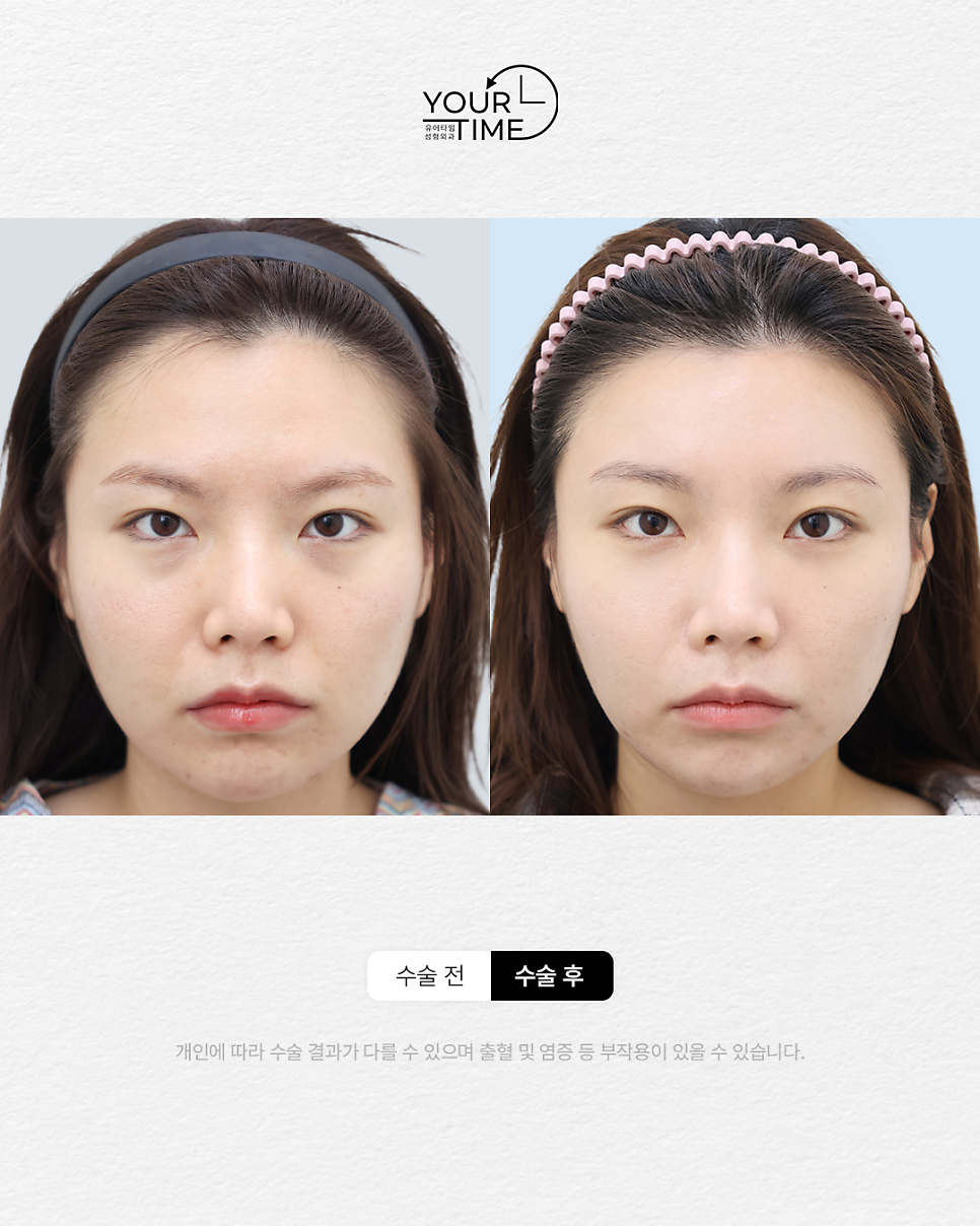 Forehead Reduction Self-Check List: Should You Get the Surgery or Not? — 14