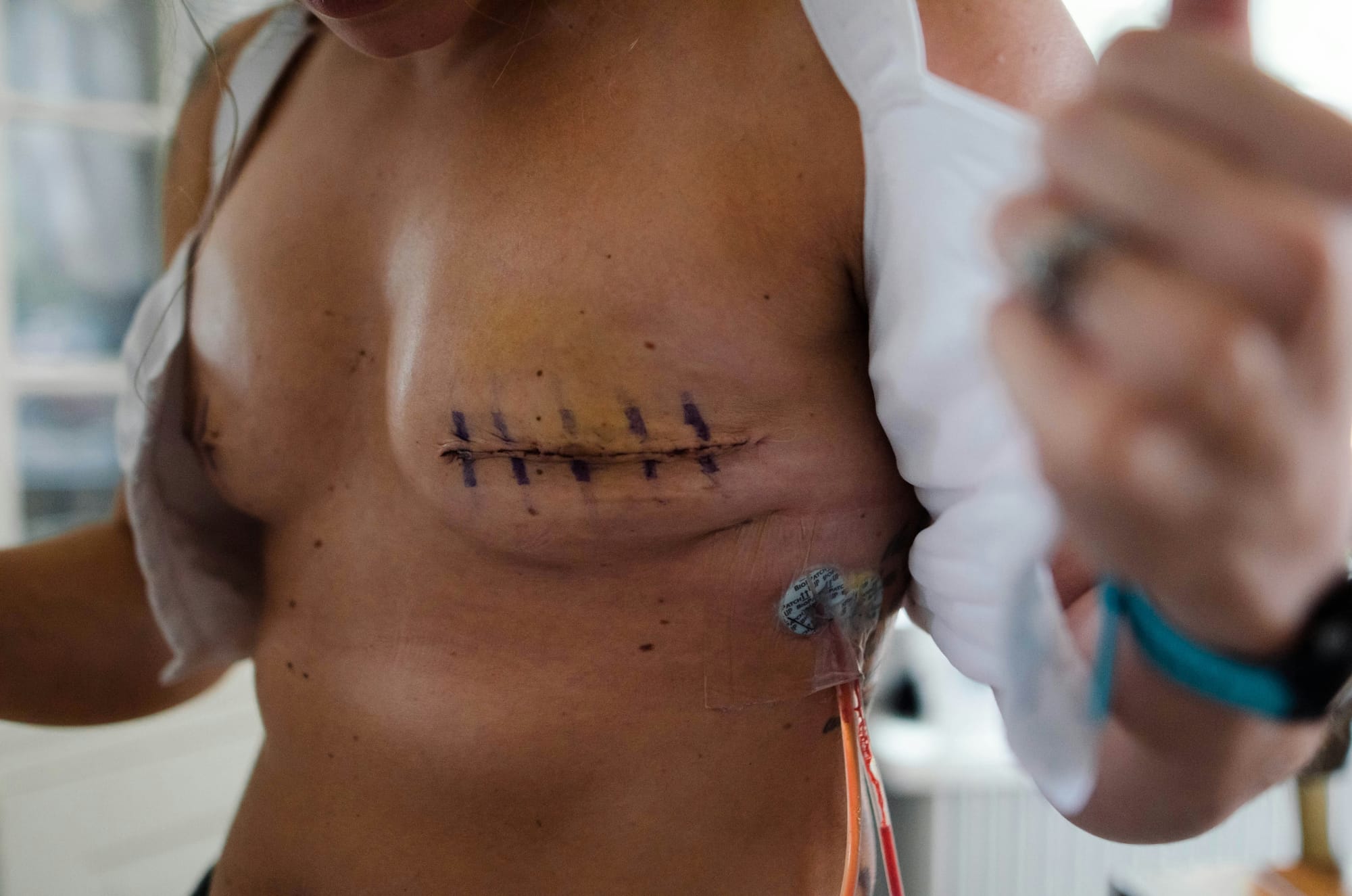 A post-mastectomy chest with a large scar where a nipple was