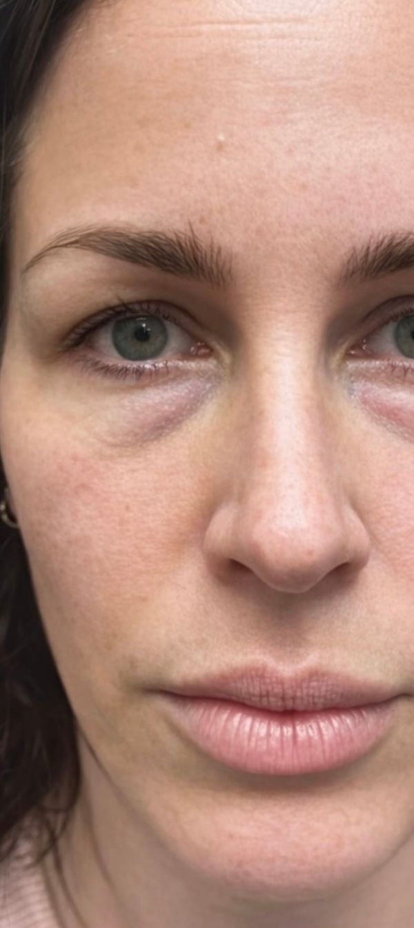Ce creux sous les yeux, faut-il vraiment l’injecter ?