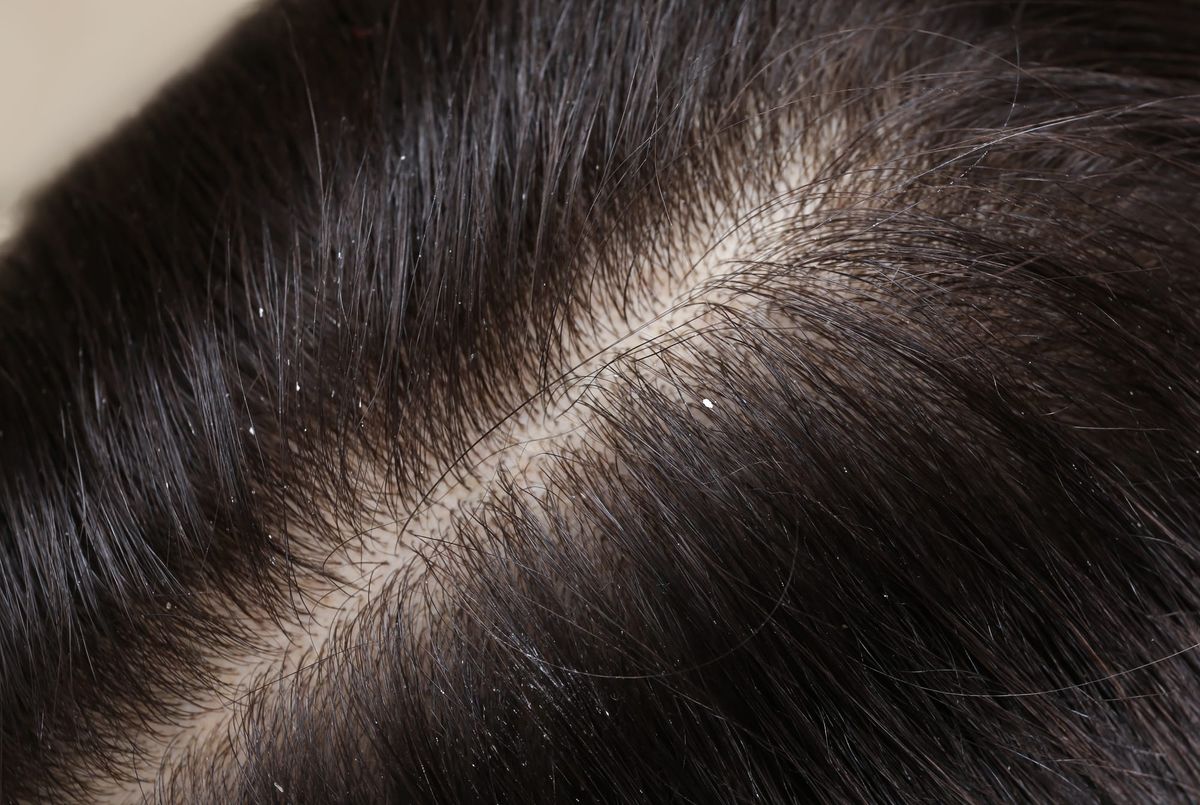Dry Shampoo Is the "Fast Food" of Hair Care: Is Your Convenience Costing You Your Density?