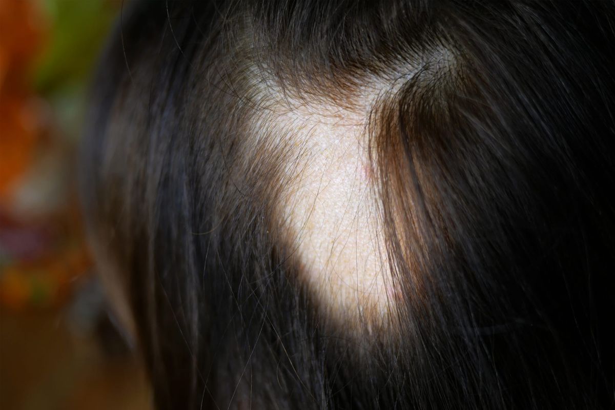 The Telogen Shedding Surge: Why Topical Treatments Can't Fix an Empty Internal Pipeline
