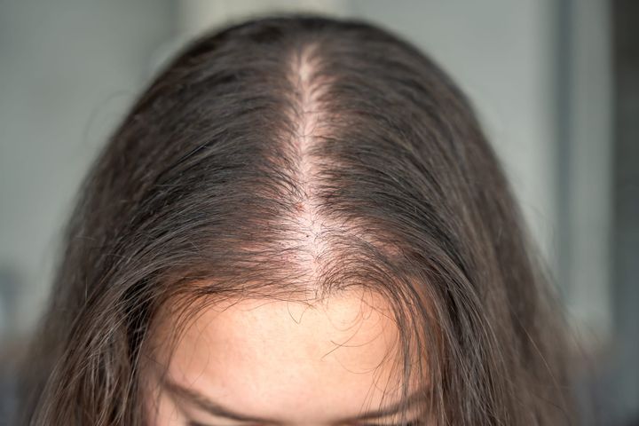 The Iron Mimic: Why Normal Ferritin Levels Can Still Cause Severe Hair Thinning