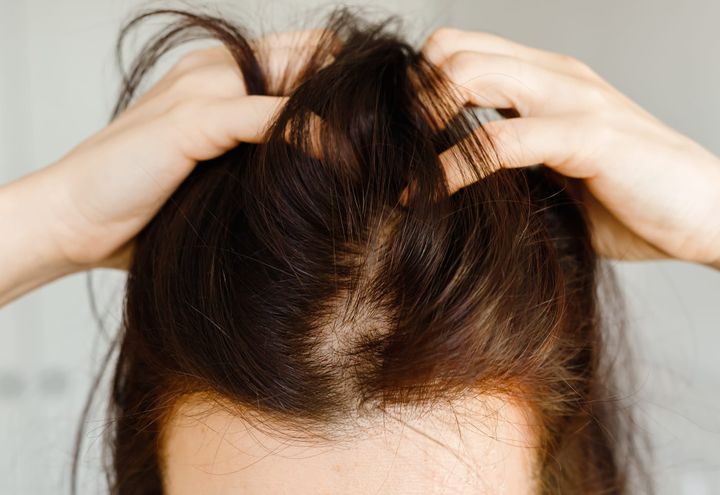 Why a Sore Scalp Means Your Natural Oils Have Turned Harmful