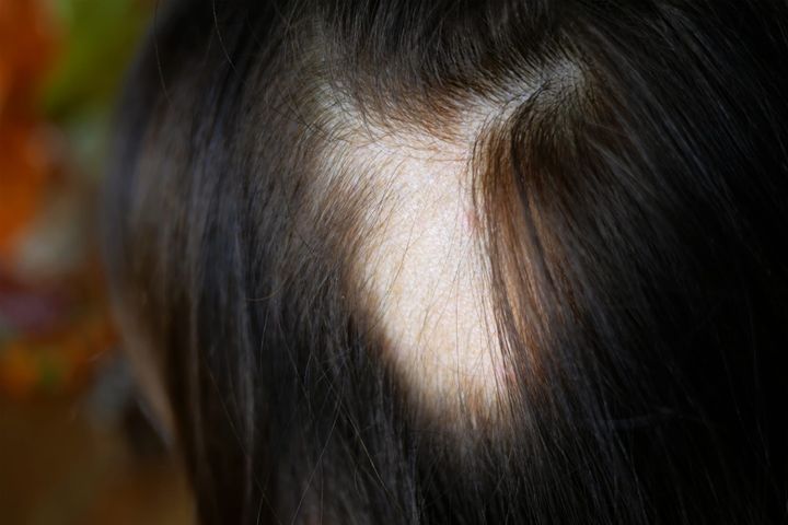 The Telogen Shedding Surge: Why Topical Treatments Can't Fix an Empty Internal Pipeline