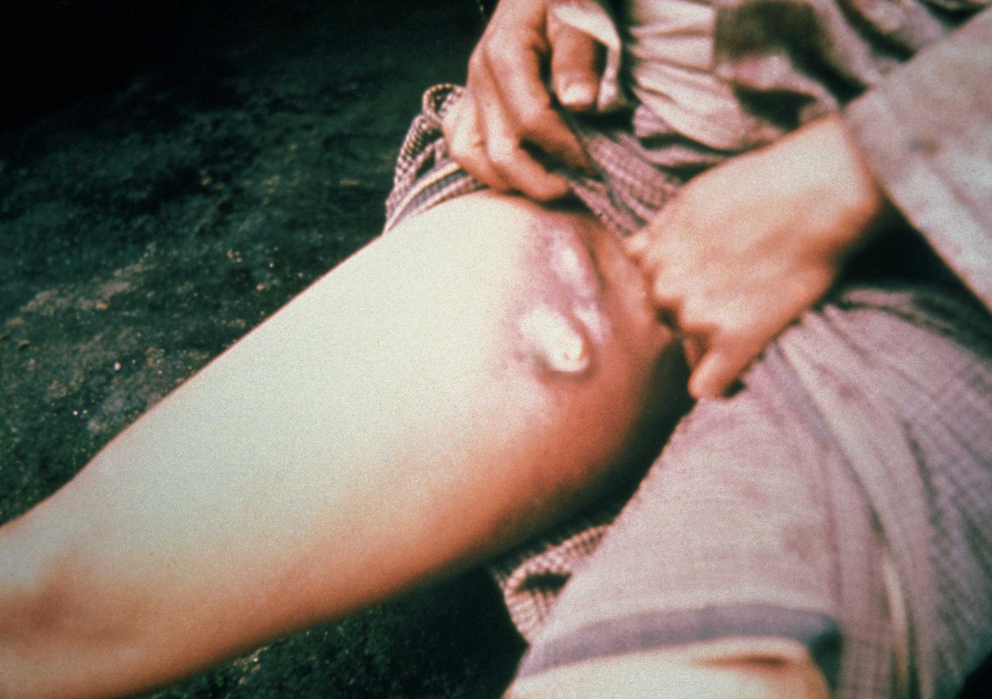 A typical symptom of the bubonic plague, after an incubation period of 2-6 days, pain and swelling appear, or adenopathy, in the affected regional lymph nodes, also known as buboes