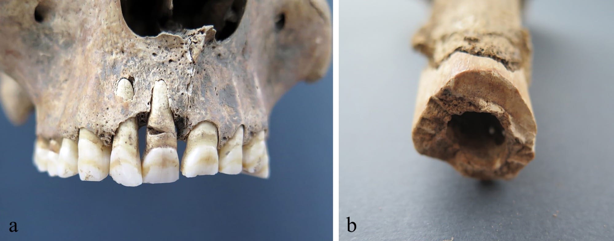 Two close-up photographs of SK 4 from the Mursa well: a broken upper front tooth on the left and a cut across the shaft of a left upper-arm bone on the right.