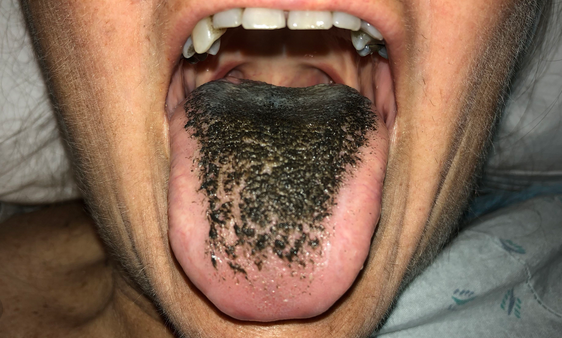 La langue noire chevelue, un nouveau symptôme du Covid-19