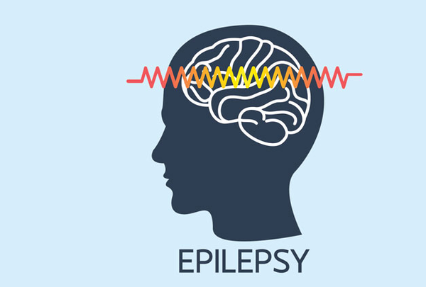 Une étude révèle que le risque d’épilepsie post-Covid est plus élevé qu’après une grippe