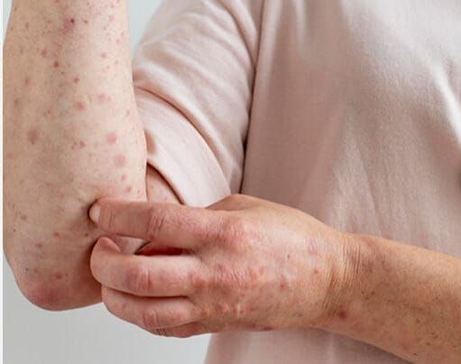 Royaume-Uni : point sur les cas de lèpre liés au vaccin Pfizer