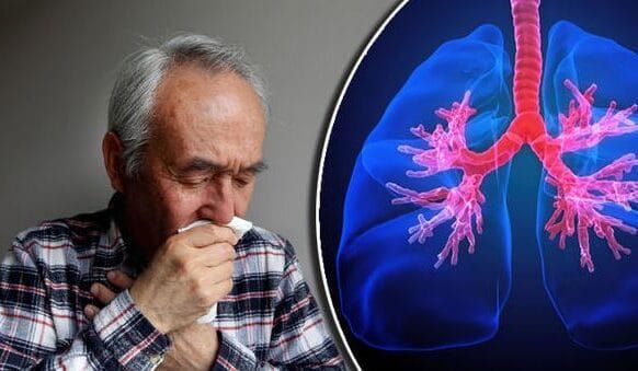 La ferroptose à l’origine des séquelles du COVID sur les poumons, selon une étude