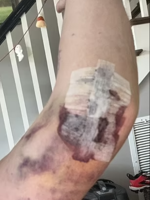 USA: une infirmière victime d’une nécrose des os après injection Pfizer