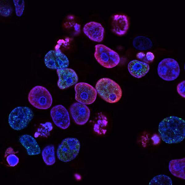 A new breast cancer classification could drastically change your treatment options.