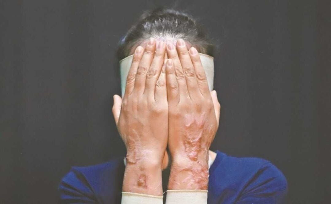 Proponen en Edomex cirugías reconstructivas gratis y hasta 30 años por violencia ácida