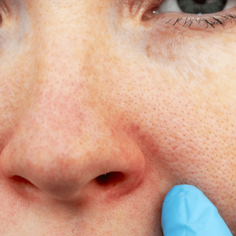 picture of red dry nose