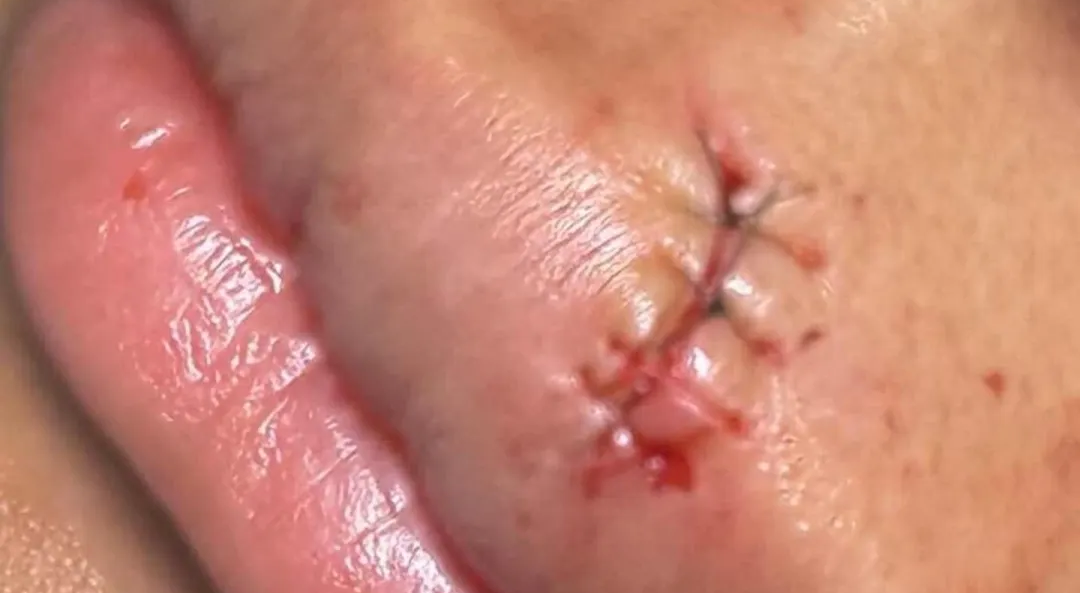 新西兰少女补牙，嘴唇被割裂，“牙医自己都吓懵了”