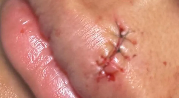 新西兰少女补牙，嘴唇被割裂，“牙医自己都吓懵了”