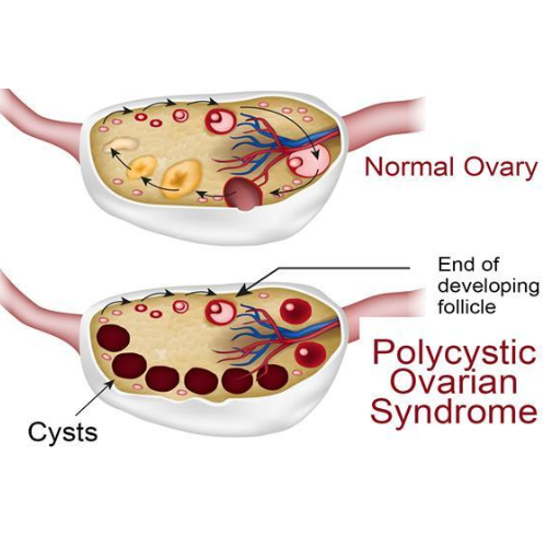 Illustration showing difference between healthy ovary and PCOS ovary