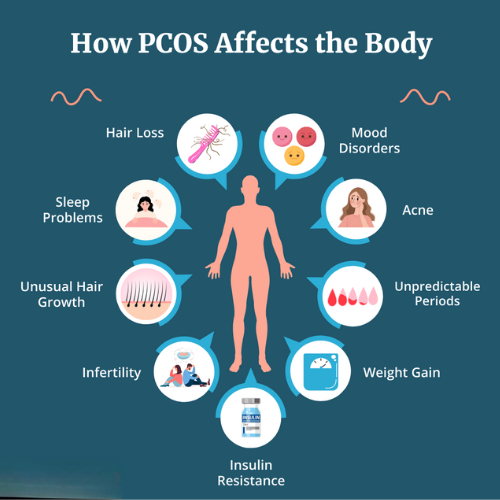  PCOS symptoms infographic including acne, irregular periods, weight gain