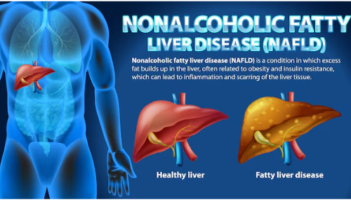 Comparison of healthy liver and non-alcoholic fatty liver