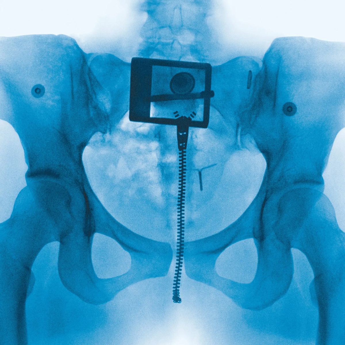 X-ray of a pelvis showing a surgical screw and plate fixation device implanted at the sacrum for spinal stabilization.