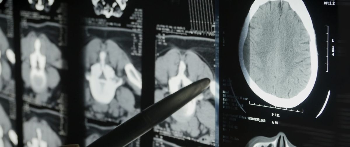 CT scan images displayed on a monitor showing brain and abdominal cross-sections, with a pen pointing at the scans.