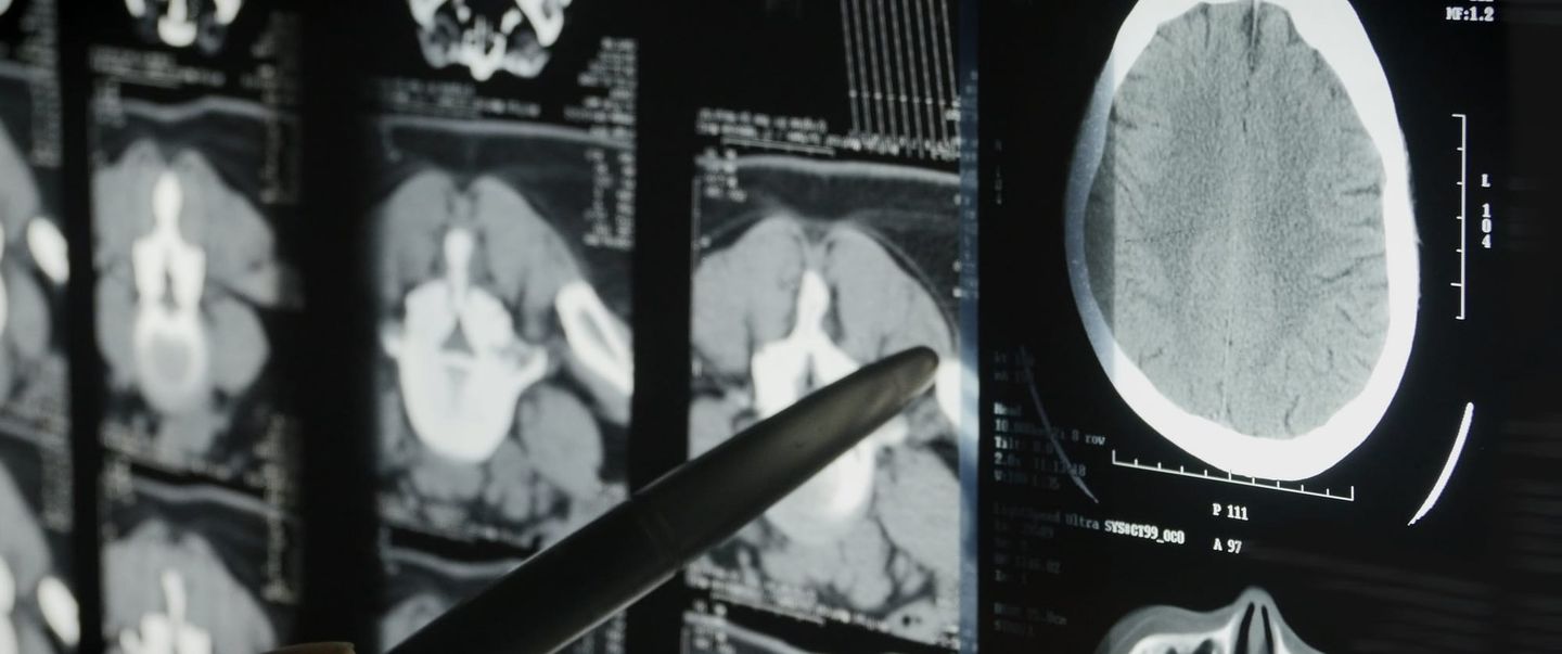 CT scan images displayed on a monitor showing brain and abdominal cross-sections, with a pen pointing at the scans.