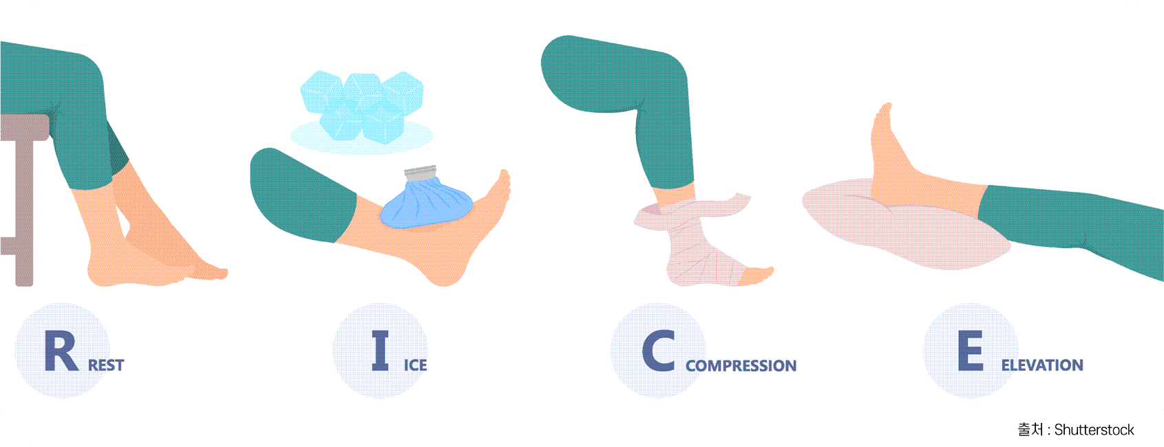 RICE 방법을 나타내는 그림