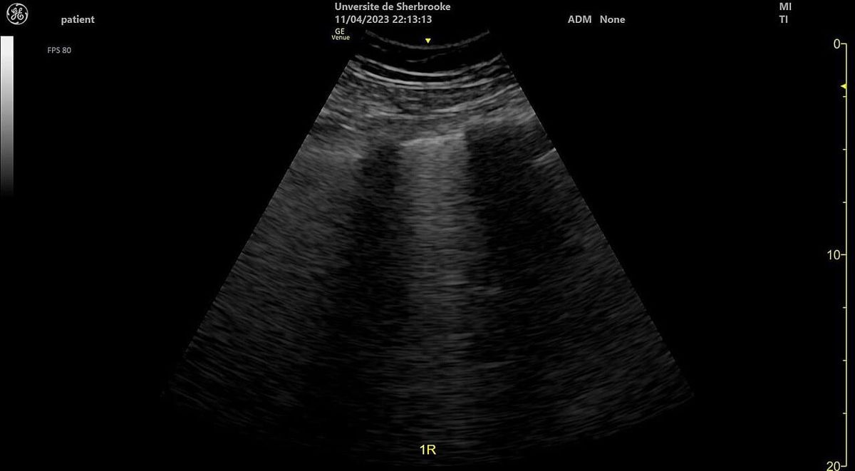 Líneas B en ultrasonido pulmonar: del artefacto a la decisión clínica