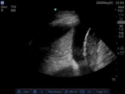 Derrame pleural en ultrasonido: detectar, caracterizar y decidir con seguridad