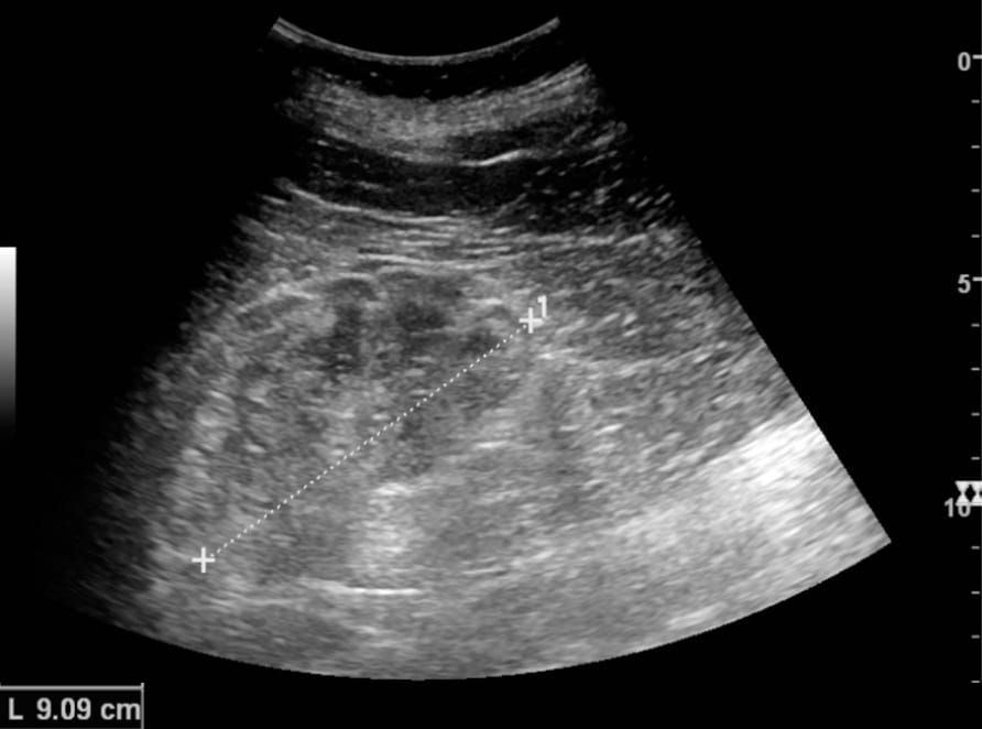 Riñón crónico en ultrasonido: interpretar tamaño, ecogenicidad y cortical sin confundir cronicidad con irreversibilidad