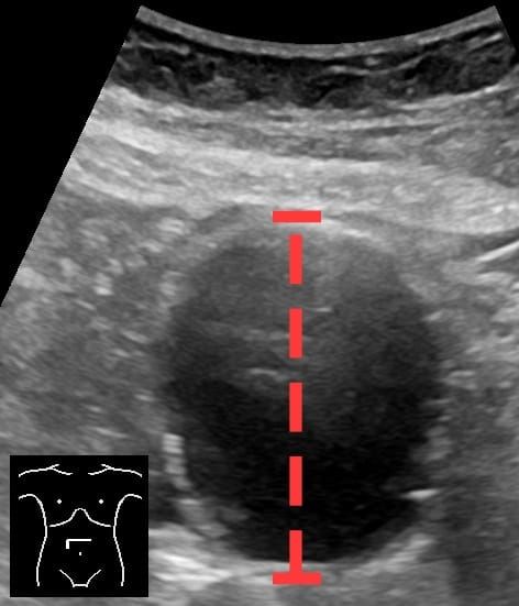 Ecografía axial de un aneurisma aórtico abdominal con línea de medición anteroposterior.