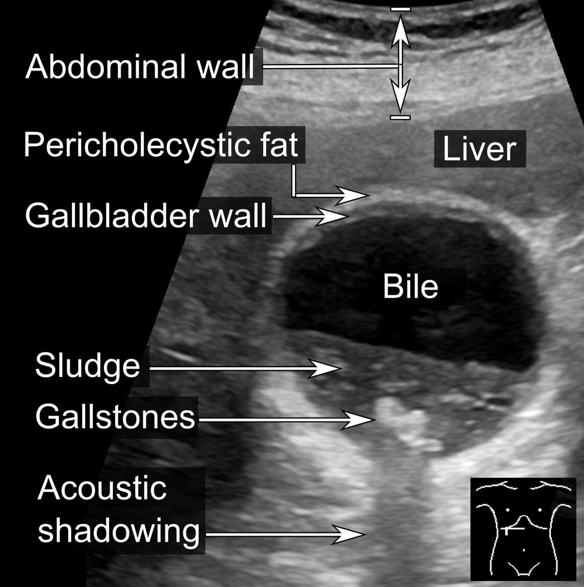 Ecografía anotada de vesícula con barro biliar, cálculos y sombra acústica posterior.