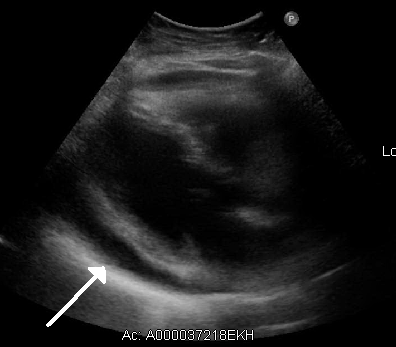 Ecocardiografía que muestra líquido alrededor del corazón compatible con derrame pericárdico