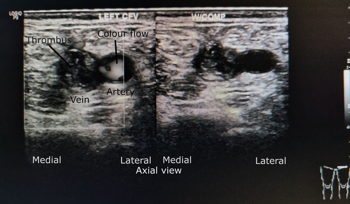 Imagen ecográfica transversal de la vena femoral común izquierda antes y durante la compresión; la vena no colapsa por trombo.
