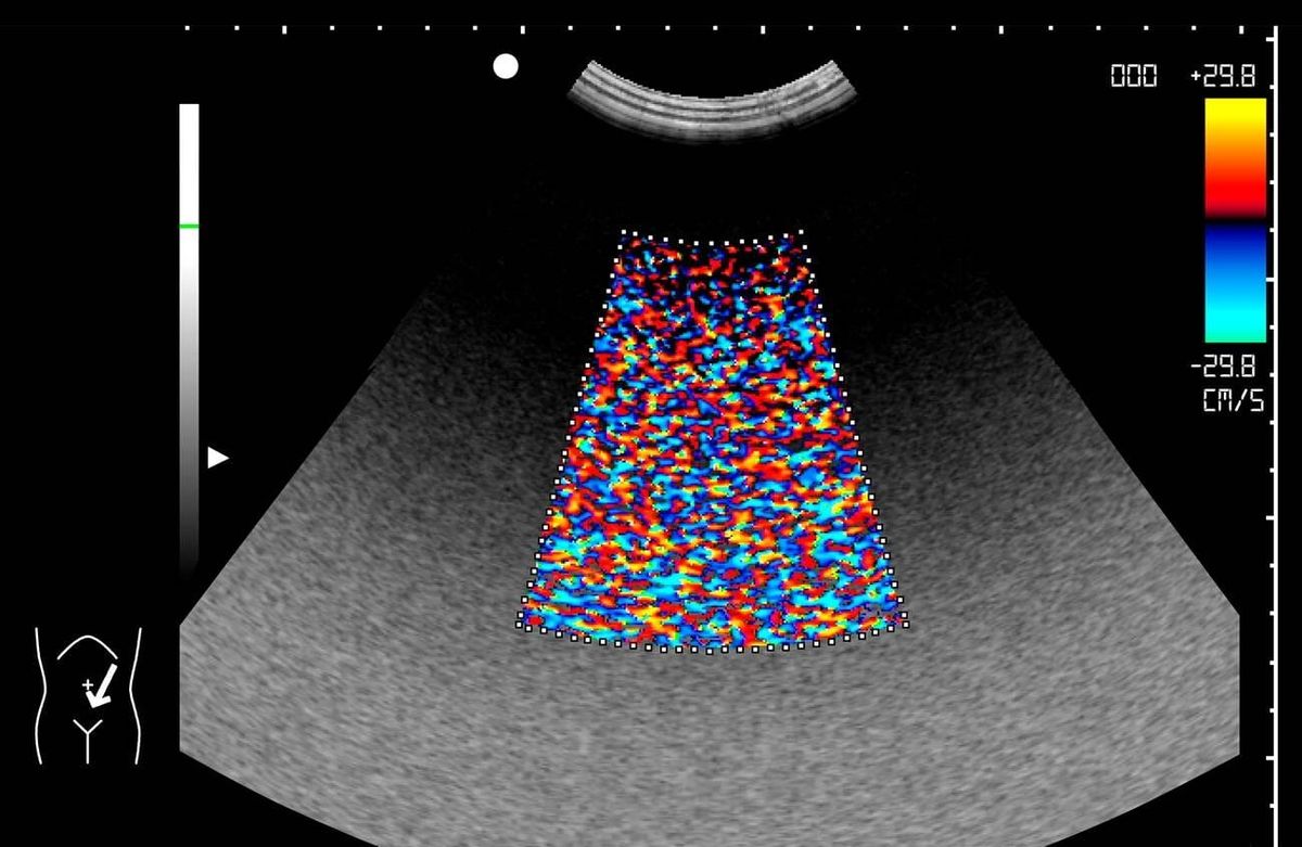 Ecografía Doppler color con mosaico rojo, azul y amarillo por ruido y artefacto flash durante una exploración abdominal