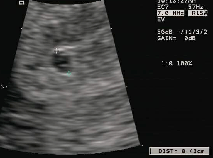 Ecografía de un saco gestacional intrauterino pequeño con saco vitelino visible en su interior.