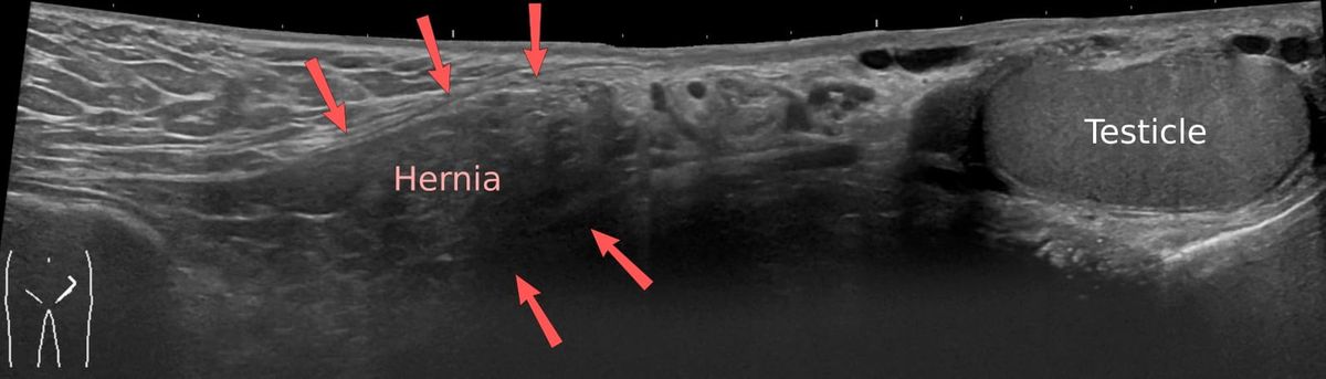 Ecografía longitudinal anotada de una hernia inguinal indirecta con contenido graso señalado por flechas.