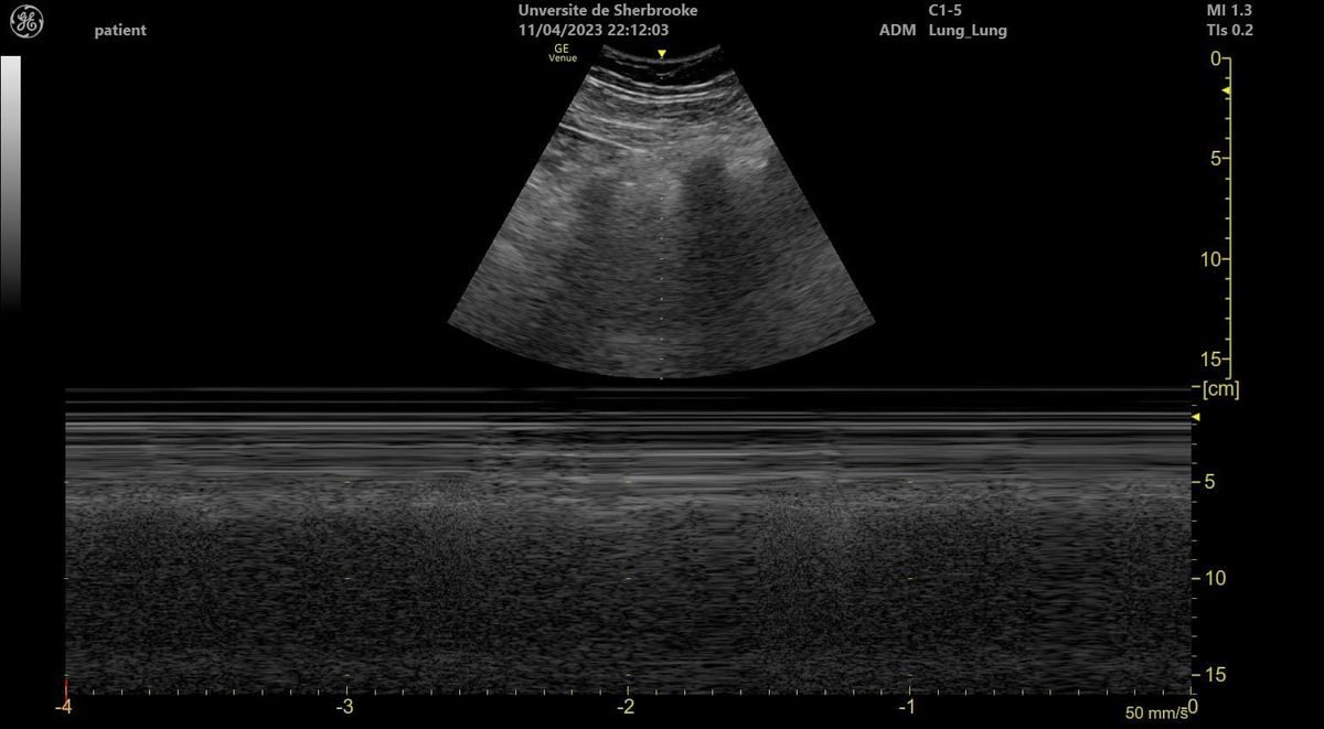 Ecografía pulmonar en modo M con signo de la orilla de mar: líneas horizontales superficiales y textura granular bajo la pleura.