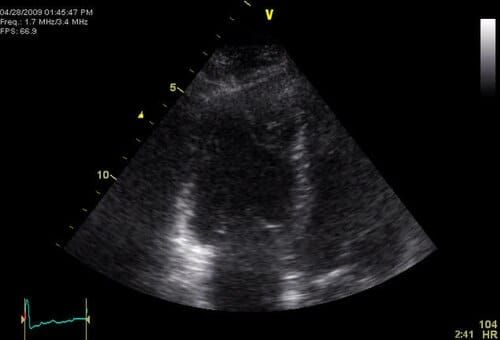 Ecocardiografía apical de cuatro cámaras con signo de McConnell por embolia pulmonar masiva