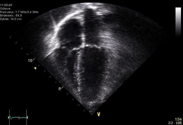 Vista ecocardiográfica apical de cuatro cámaras utilizada para delimitar el ventrículo izquierdo