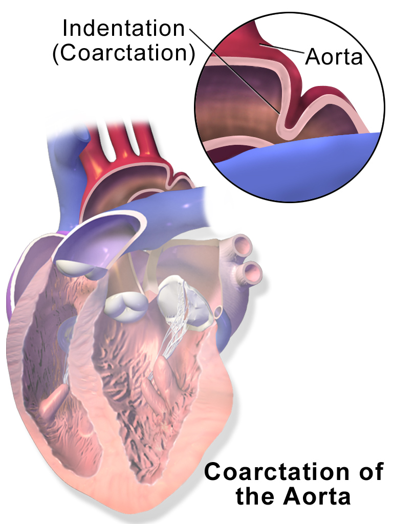 Ilustración anatómica de coartación aórtica con detalle ampliado del estrechamiento y rótulos en inglés; no representa un registro ecográfico ni una medición Doppler