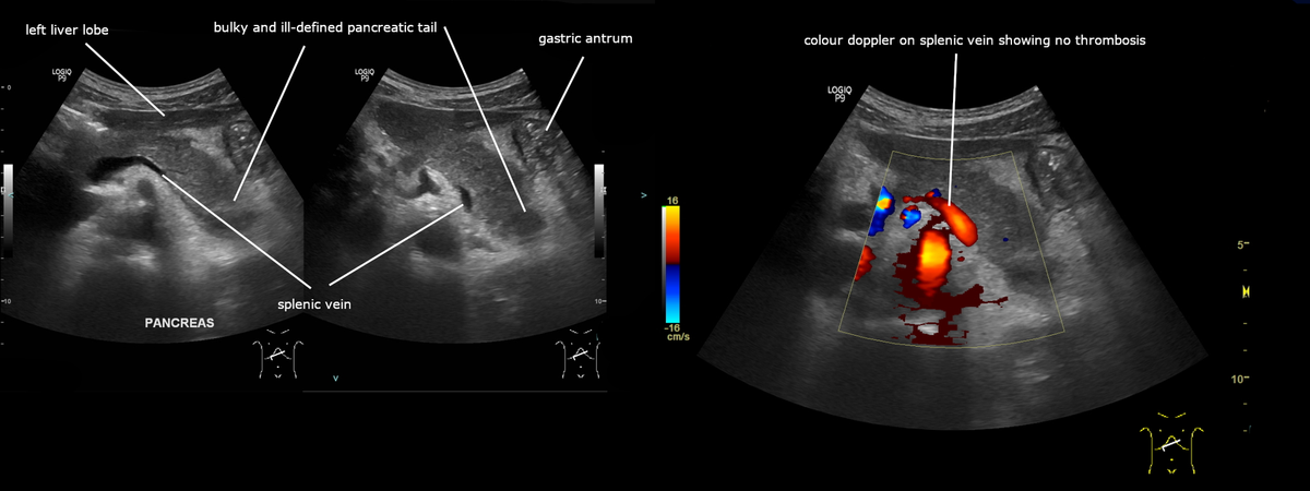 Ecografía con cola pancreática aumentada y de límites poco definidos, y Doppler color de la vena esplénica