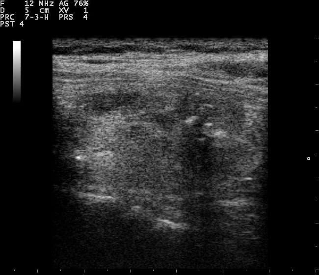 Ecografía de un nódulo tiroideo con ecogenicidad heterogénea y focos brillantes con sombra posterior