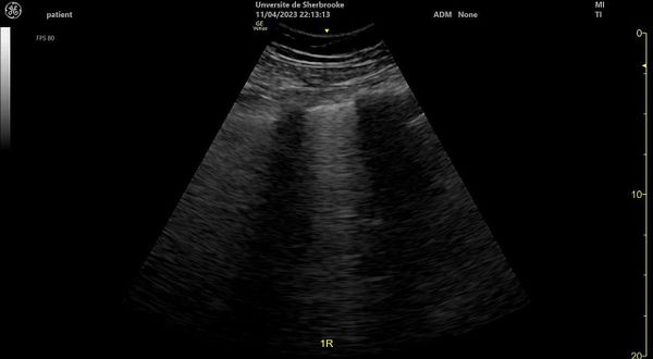 Líneas B en ultrasonido pulmonar: del artefacto a la decisión clínica
