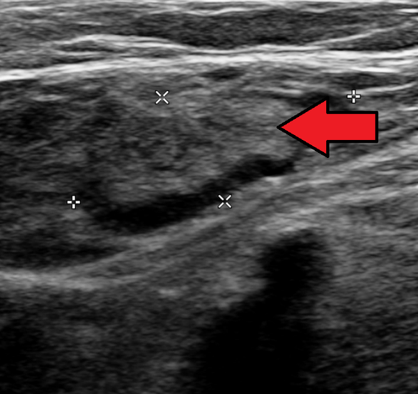 Ecografía de la ingle con trombosis de la vena femoral señalada por una flecha roja.